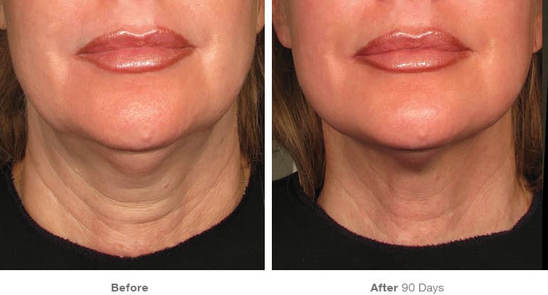 Resultados del tratamiento Ultherapy