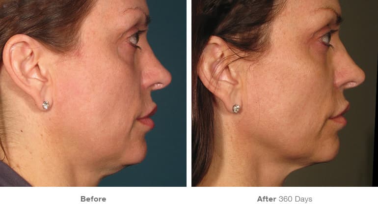 Resultados del tratamiento Ultherapy