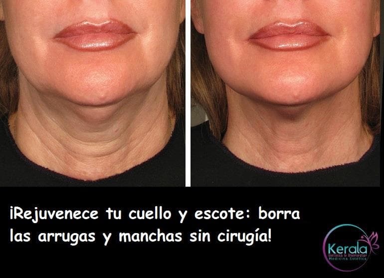 ¡Rejuvenece tu cuello y escote en el Centro de Estética Bienestar Kerala!