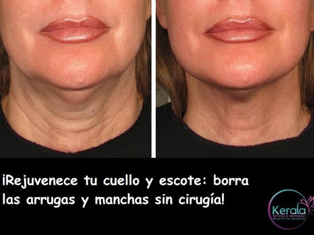 ¡Rejuvenece tu cuello y escote en el Centro de Estética Bienestar Kerala!